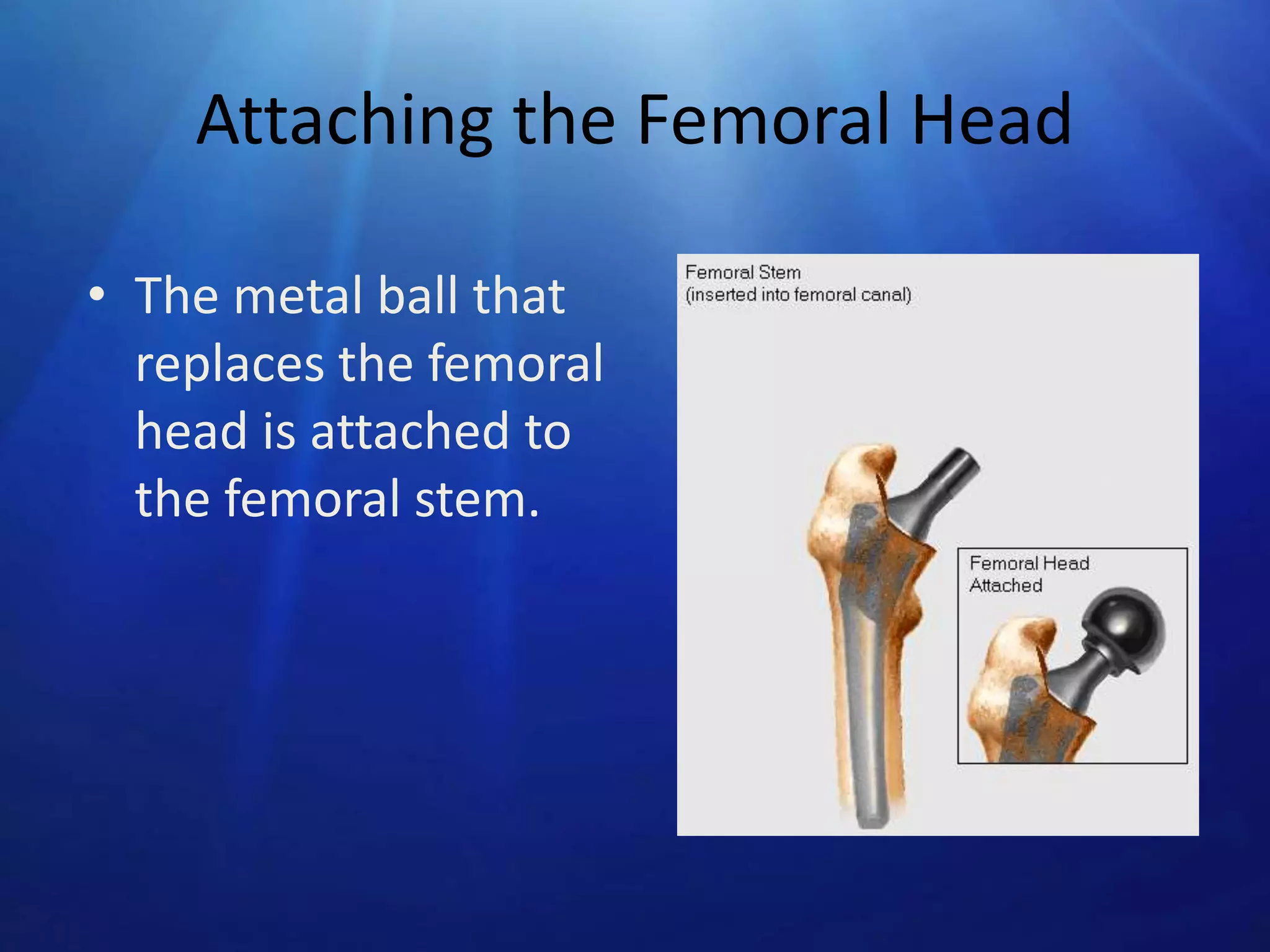 Attaching the Femoral Head
• The metal ball that
replaces the femoral
head is attached to
the femoral stem.

 