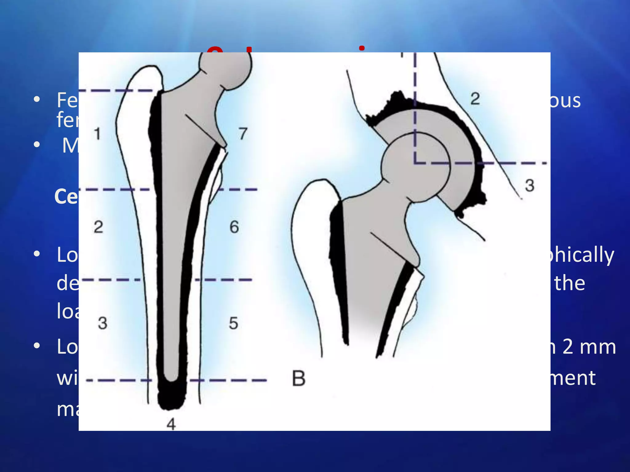 9. Loosening :
• Femoral and acetabular loosening are the most serious
femoral and acetabular long-term complications.
• Most common indications for revision arthroplasty.
Cemented femoral loosening :

• Loosening of a femoral stem as defined as radiographically
demonstrable change in the mechanical integrity of the
load carrying cemented femoral component.
• Loosening is present if a radiolucent zone more than 2 mm
wide is seen. Especially if noted about the entire cement
mass and if it is increased progressively in width.

 