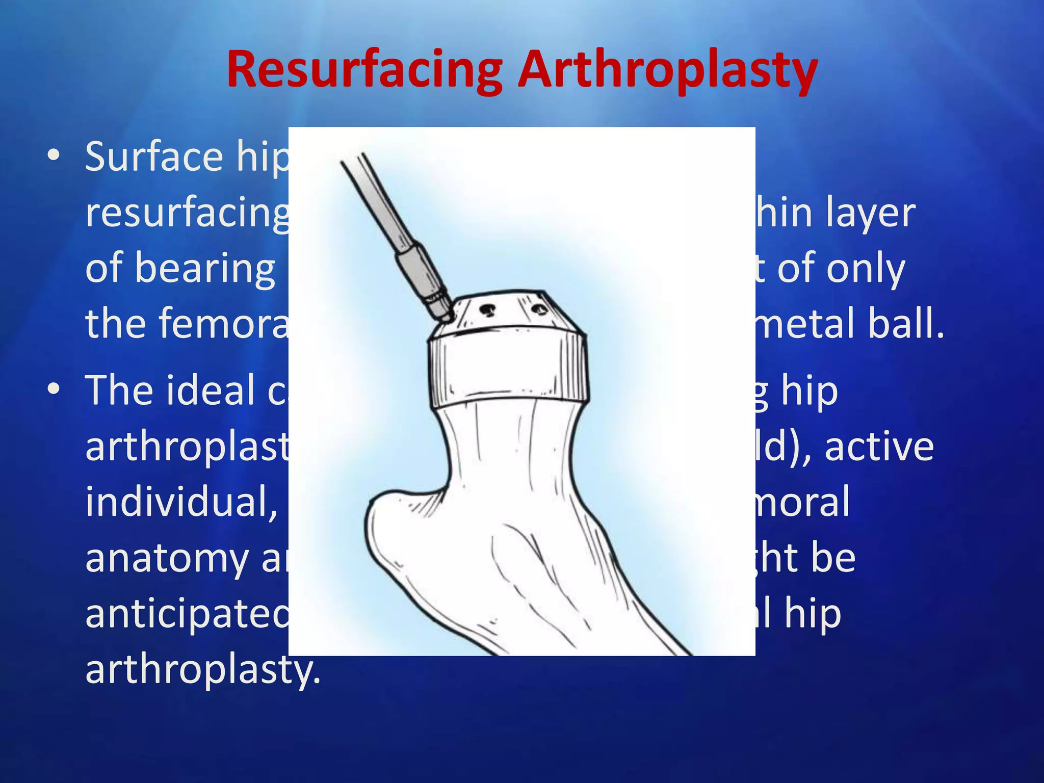 Resurfacing Arthroplasty
• Surface hip replacement consists of
resurfacing the acetabulum with a thin layer
of bearing surface, and replacement of only
the femoral head (not neck) with a metal ball.
• The ideal candidate for a resurfacing hip
arthroplasty is a young (<60 years old), active
individual, with normal proximal femoral
anatomy and bone density who might be
anticipated to outlive a conventional hip
arthroplasty.

 