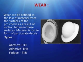 WEAR :
Wear can be defined as
the loss of material from
the surfaces of the
prosthesis as a result of
motion between those
surfaces. Material is lost in
form of particulate debris.
Types :
Abrasive-THR
Adhesive -THR
Fatigue - TKR

 