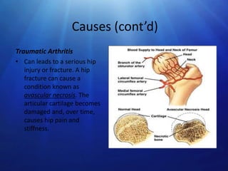 Causes (cont’d)
Traumatic Arthritis
• Can leads to a serious hip
injury or fracture. A hip
fracture can cause a
condition known as
avascular necrosis. The
articular cartilage becomes
damaged and, over time,
causes hip pain and
stiffness.

 