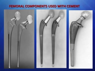FEMORAL COMPONENTS USED WITH CEMENT

 