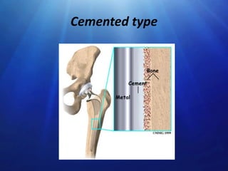 Cemented type

 