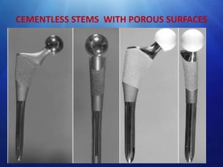 CEMENTLESS STEMS WITH POROUS SURFACES

 
