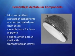 Cementless Acetabular Components
• Most cementless
acetabular components
are porous coated over
their entire
circumference for bone
ingrowth
• Fixation of the porous
shell with
transacetabular screws

 