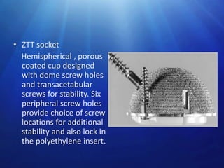 • ZTT socket
Hemispherical , porous
coated cup designed
with dome screw holes
and transacetabular
screws for stability. Six
peripheral screw holes
provide choice of screw
locations for additional
stability and also lock in
the polyethylene insert.

 