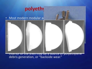 polyethylene liner
• Most modern modular acetabular components are
supplied with a variety of polyethylene liner choices
• The polyethylene liner must be fastened securely to
the metal shell.
• Current mechanisms include plastic flanges and metal
wire rings that lock behind elevations or ridges in the
metal shell, and peripherally placed screws
• in vivo dissociation of polyethylene liners from their
metal backings has been reported micromotion
between the nonarticulating side of the liner and the
interior of the shell may be a source of polyethylene
debris generation, or “backside wear.”

 