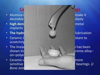 Ceramic-on-Ceramic Bearings
• Alumina ceramic has many properties that make it
desirable as a bearing surface in hip arthroplasty
• high density- surface finish smoother than metal
implants
• The hydrophilic nature- ceramic promotes lubrication
• Ceramic is harder than metal and more resistant to
scratching from third-body wear particles.
• The linear wear rate of alumina-on-alumina has been
shown to be 4000 times less than cobalt-chrome alloy–
on–polyethylene.
• Ceramic-on-ceramic arthroplasties may be more
sensitive to implant malposition than other bearings. (J
Bone Joint Surg [Br] 2003;85-B:650-4

 