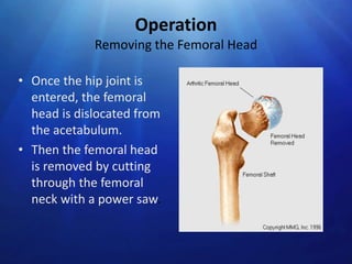 Operation
Removing the Femoral Head
• Once the hip joint is
entered, the femoral
head is dislocated from
the acetabulum.
• Then the femoral head
is removed by cutting
through the femoral
neck with a power saw.

 