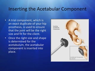Inserting the Acetabular Component
• A trial component, which is
an exact duplicate of your hip
prosthesis, is used to ensure
that the joint will be the right
size and fit for the client.
• Once the right size and shape
is determined for the
acetabulum, the acetabular
component is inserted into
place.

 
