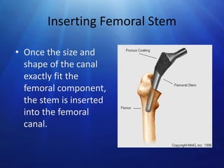 Inserting Femoral Stem
• Once the size and
shape of the canal
exactly fit the
femoral component,
the stem is inserted
into the femoral
canal.

 