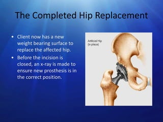 The Completed Hip Replacement
• Client now has a new
weight bearing surface to
replace the affected hip.
• Before the incision is
closed, an x-ray is made to
ensure new prosthesis is in
the correct position.

 
