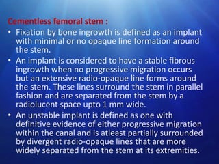 Cementless femoral stem :
• Fixation by bone ingrowth is defined as an implant
with minimal or no opaque line formation around
the stem.
• An implant is considered to have a stable fibrous
ingrowth when no progressive migration occurs
but an extensive radio-opaque line forms around
the stem. These lines surround the stem in parallel
fashion and are separated from the stem by a
radiolucent space upto 1 mm wide.
• An unstable implant is defined as one with
definitive evidence of either progressive migration
within the canal and is atleast partially surrounded
by divergent radio-opaque lines that are more
widely separated from the stem at its extremities.

 