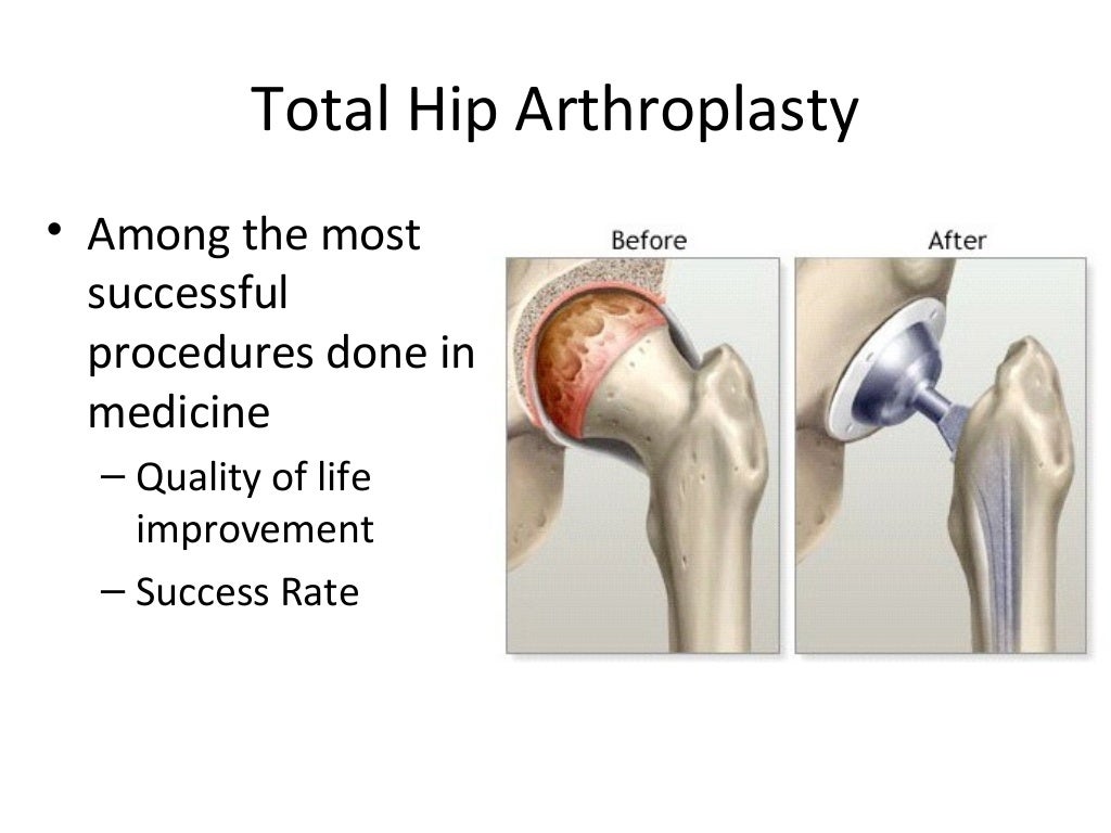 Hip Injuries in Athletes 2015