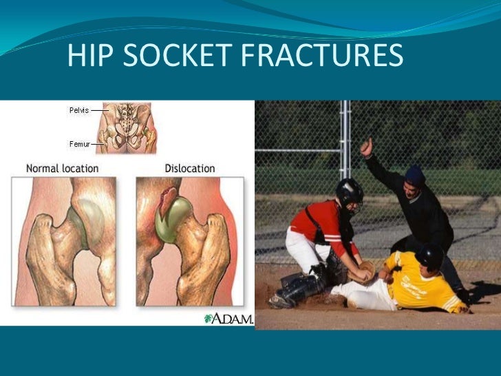 Hip Injuries In The Athelete+Arthroscopy Of The Hip