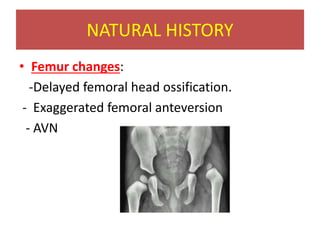 NATURAL HISTORY
• Femur changes:
-Delayed femoral head ossification.
- Exaggerated femoral anteversion
- AVN
 