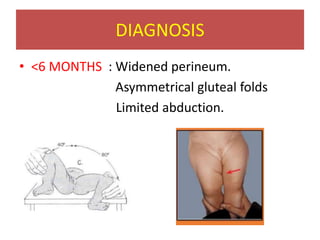 DIAGNOSIS
• <6 MONTHS : Widened perineum.
Asymmetrical gluteal folds
Limited abduction.
 