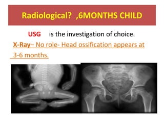 Radiological? ,6MONTHS CHILD
USG is the investigation of choice.
X-Ray– No role- Head ossification appears at
3-6 months.
 