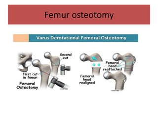 Femur osteotomy
 