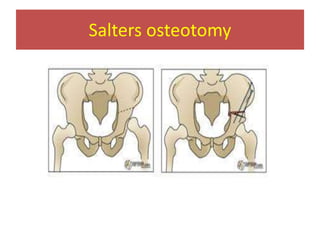 Salters osteotomy
 