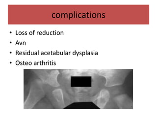 complications
• Loss of reduction
• Avn
• Residual acetabular dysplasia
• Osteo arthritis
 