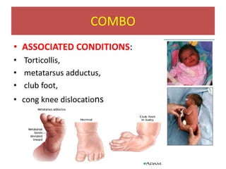 COMBO
• ASSOCIATED CONDITIONS:
• Torticollis,
• metatarsus adductus,
• club foot,
• cong knee dislocations
 