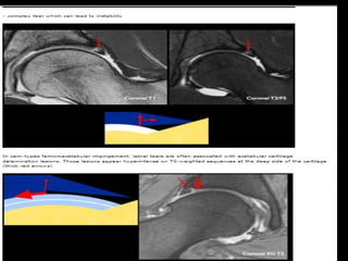 Hip joint | PPT