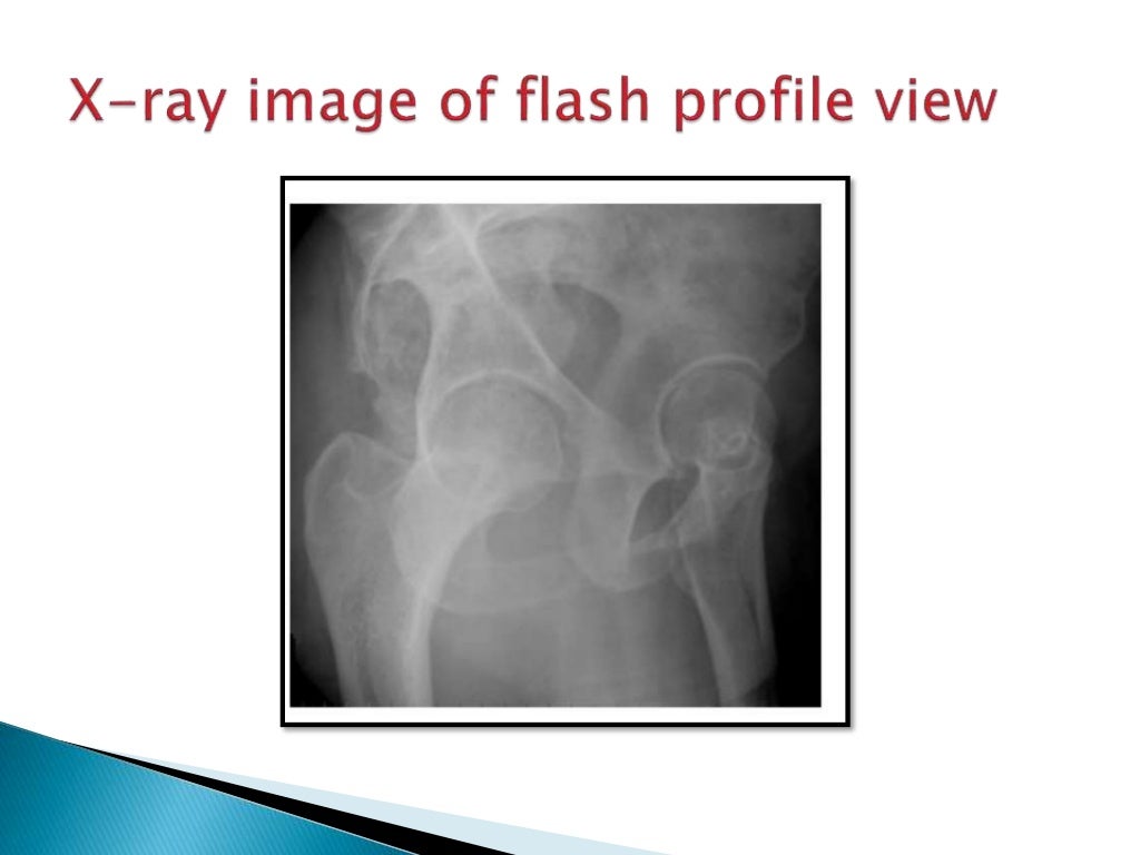 RADIOGRAPHIC VIEWS FOR HIP JOINT