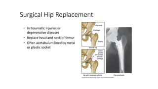 Surgical Hip Replacement
• In traumatic injuries or
degenerative diseases
• Replace head and neck of femur
• Often acetabulum lined by metal
or plastic socket
 
