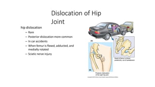 Dislocation of Hip
Joint
hip dislocation
– Rare
– Posterior dislocation more common
– In car accidents
– When femur is flexed, adducted, and
medially rotated
– Sciatic nerve injury
 