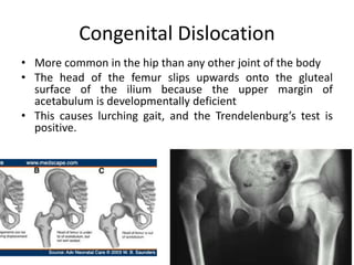 Congenital Dislocation
• More common in the hip than any other joint of the body
• The head of the femur slips upwards onto the gluteal
surface of the ilium because the upper margin of
acetabulum is developmentally deficient
• This causes lurching gait, and the Trendelenburg’s test is
positive.
 