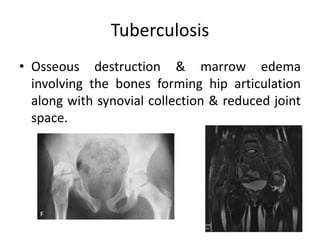 Tuberculosis
• Osseous destruction & marrow edema
involving the bones forming hip articulation
along with synovial collection & reduced joint
space.
 