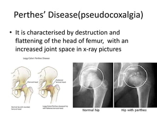 Perthes’ Disease(pseudocoxalgia)
• It is characterised by destruction and
flattening of the head of femur, with an
increased joint space in x-ray pictures
 