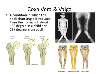 Coxa Vera & Valga
• A condition in which the
neck-shaft angle is reduced
from the normal of about
150 degree in a child and
127 degree in an adult
 