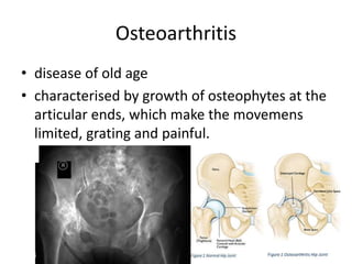 Osteoarthritis
• disease of old age
• characterised by growth of osteophytes at the
articular ends, which make the movemens
limited, grating and painful.
 
