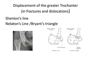 Displacement of the greater Trochanter
(in fractures and dislocations)
Shenton’s line
Nelaton’s Line /Bryant’s triangle
 