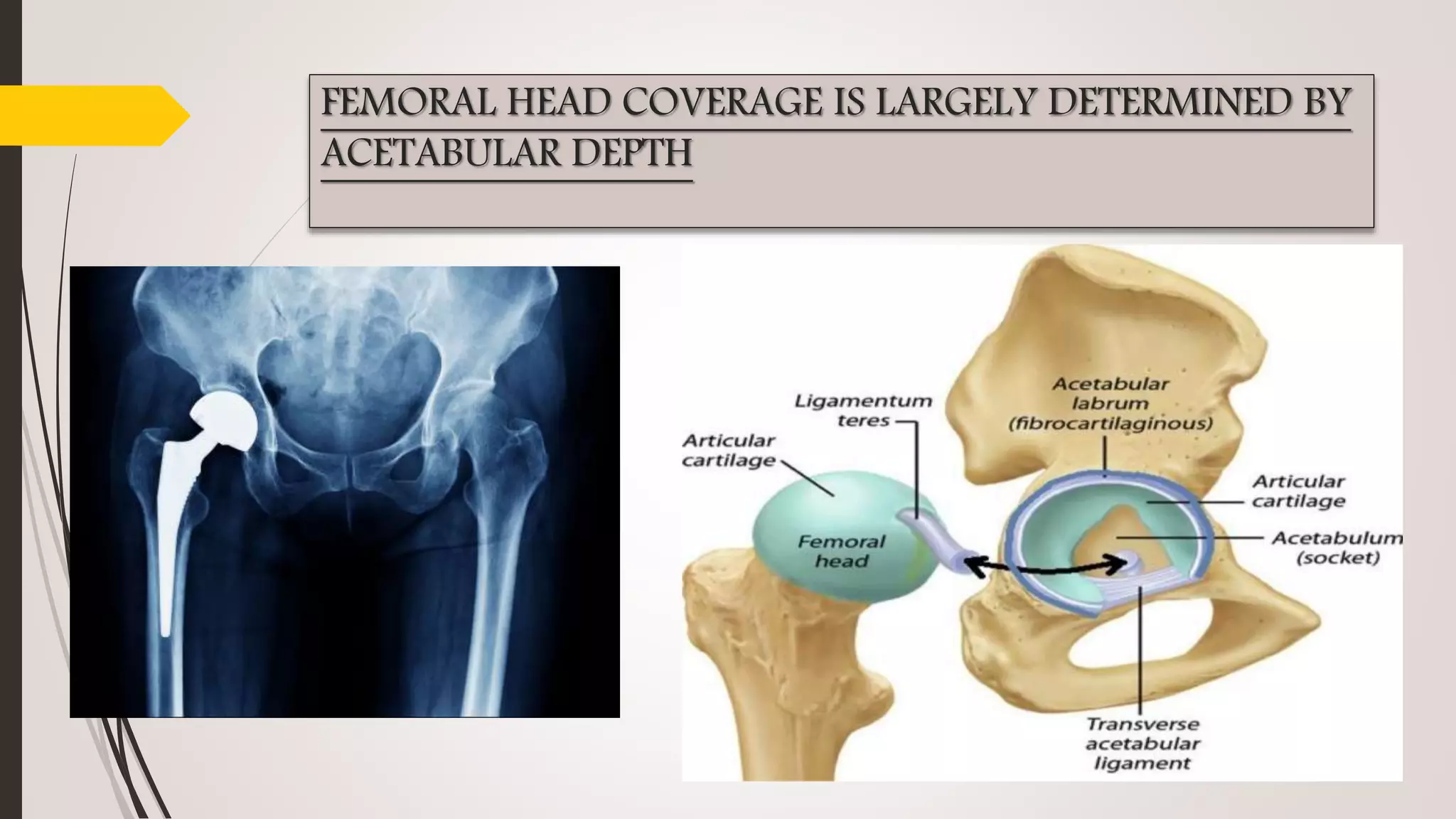 FEMORAL HEAD COVERAGE IS LARGELY DETERMINED BY
ACETABULAR DEPTH
 