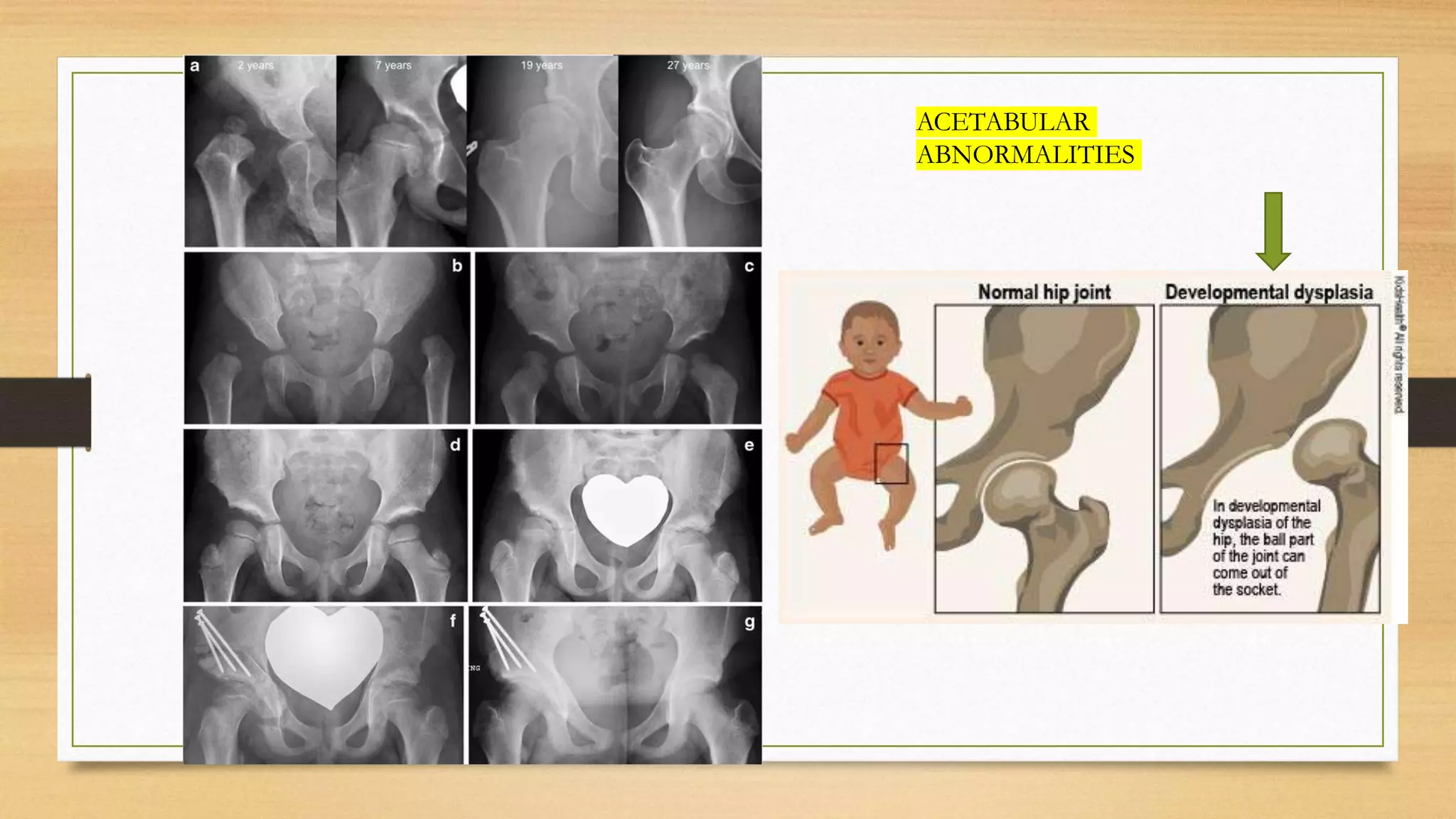ACETABULAR
ABNORMALITIES
 