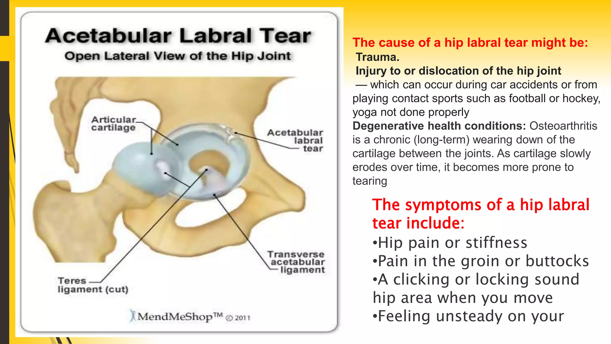 The cause of a hip labral tear might be:
Trauma.
Injury to or dislocation of the hip joint
— which can occur during car accidents or from
playing contact sports such as football or hockey,
yoga not done properly
Degenerative health conditions: Osteoarthritis
is a chronic (long-term) wearing down of the
cartilage between the joints. As cartilage slowly
erodes over time, it becomes more prone to
tearing
The symptoms of a hip labral
tear include:
•Hip pain or stiffness
•Pain in the groin or buttocks
•A clicking or locking sound
hip area when you move
•Feeling unsteady on your
 