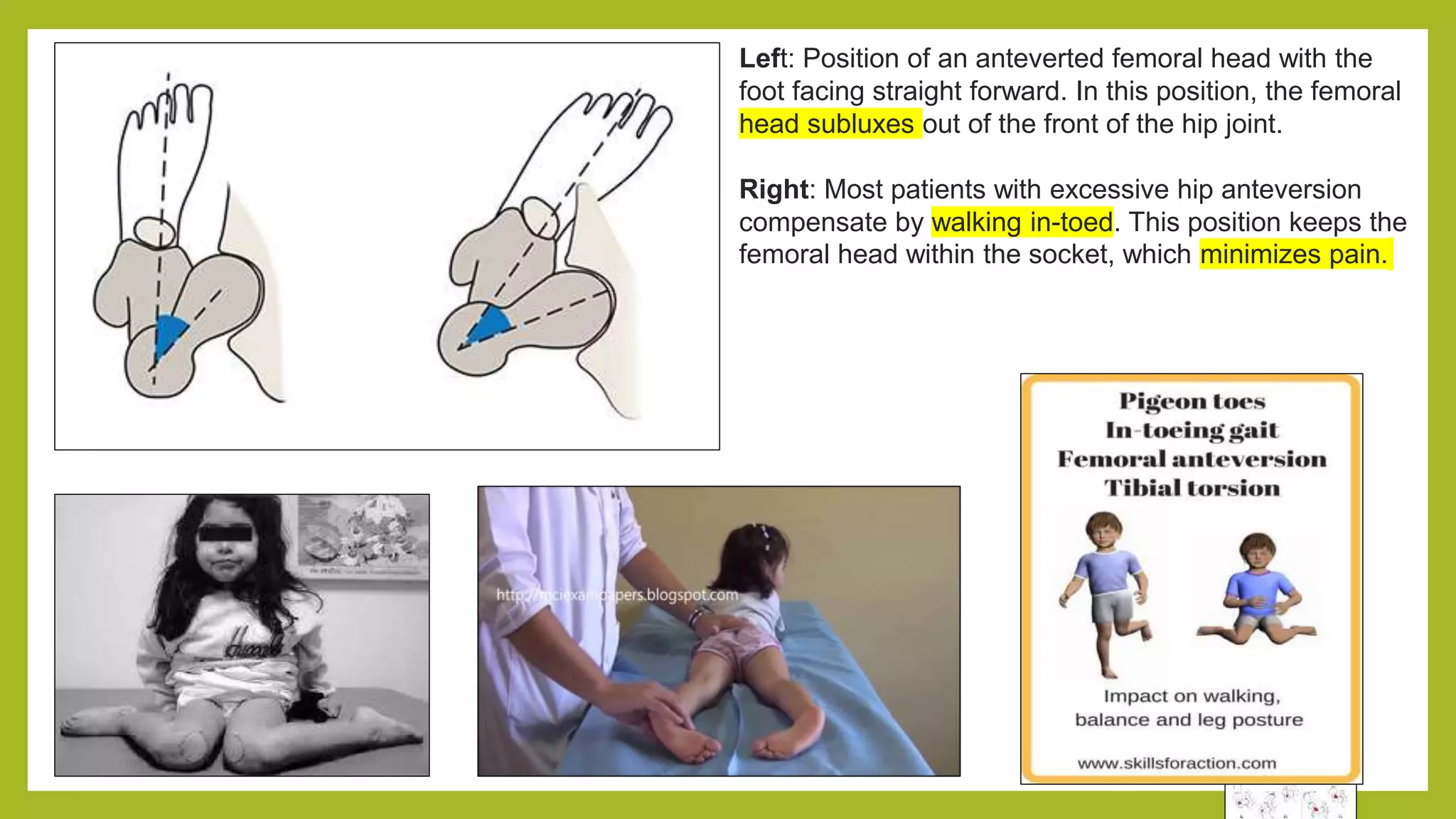 Left: Position of an anteverted femoral head with the
foot facing straight forward. In this position, the femoral
head subluxes out of the front of the hip joint.
Right: Most patients with excessive hip anteversion
compensate by walking in-toed. This position keeps the
femoral head within the socket, which minimizes pain.
 