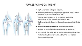 FORCES ACTING ON THE HIP
• Fig A. Lever arms acting on hip joint.
• Moment produced by body weight applied at body's center
of gravity, X, acting on lever arm, B-X,
must be counterbalanced by moment produced by
abductors, A, acting on shorter lever arm, A-B.
• Fig B. Lever arm A-B may be shorter than normal in arthritic
hip.
• Medialization of acetabulum shortens lever arm B-X,
• and use of high offset neck lengthens lever arm A-B. ,
• Fig c. Lateral and distal reattachment of osteotomized greater
trochanter lengthens lever arm A-B further and tightens
abductor musculature.
 