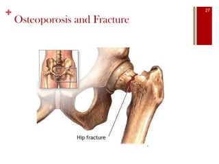 +
Osteoporosis and Fracture
27
 