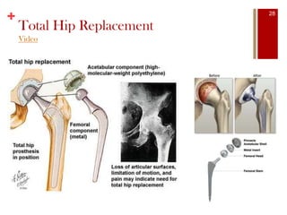 +
Total Hip Replacement
Video
28
 