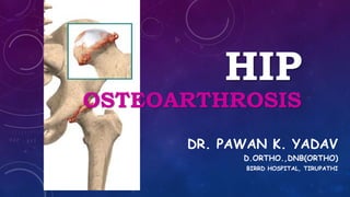 HIP
OSTEOARTHROSIS
DR. PAWAN K. YADAV
D.ORTHO.,DNB(ORTHO)
BIRRD HOSPITAL, TIRUPATHI
 