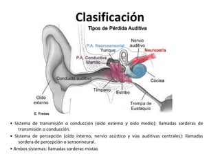 Clasificación
• Sistema de transmisión o conducción (oído externo y oído medio): llamadas sorderas de
transmisión o conducción.
• Sistema de percepción (oído interno, nervio acústico y vías auditivas centrales): llamadas
sordera de percepción o sensorineural.
• Ambos sistemas: llamadas sorderas mixtas
 