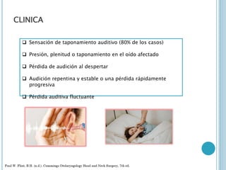 CLINICA
 Sensación de taponamiento auditivo (80% de los casos)
 Presión, plenitud o taponamiento en el oído afectado
 Pérdida de audición al despertar
 Audición repentina y estable o una pérdida rápidamente
progresiva
 Pérdida auditiva fluctuante
 