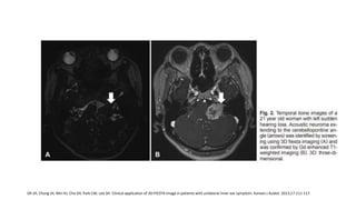Oh JH, Chung JH, Min HJ, Cho SH, Park CW, Lee SH. Clinical application of 3D-FIESTA image in patients with unilateral inner ear symptom. Korean J Audiol. 2013;17:111-117.
 