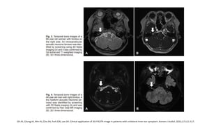 Oh JH, Chung JH, Min HJ, Cho SH, Park CW, Lee SH. Clinical application of 3D-FIESTA image in patients with unilateral inner ear symptom. Korean J Audiol. 2013;17:111-117.
 