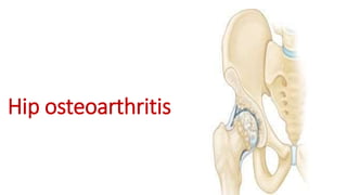 Hip osteoarthritis
 