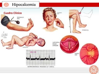 Hipocalcemia
Cuadro Clínico
 